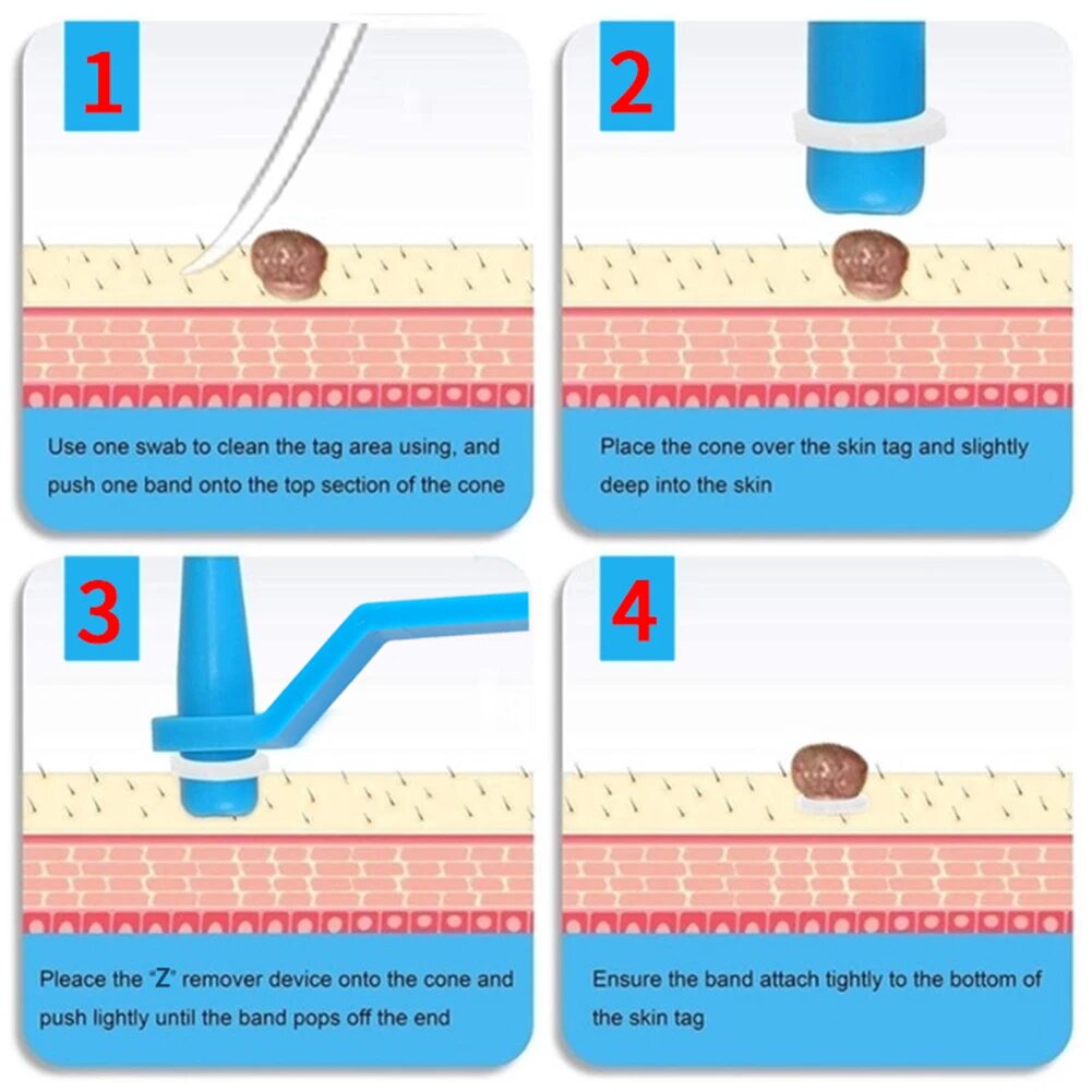 Skin Tags Removal Patches-Wart Removal Kit