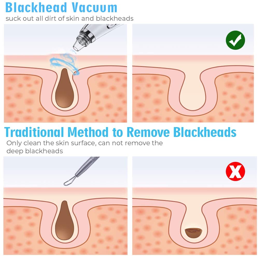 Professional and Newest Blackhead Vacuum Cleaner
