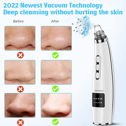 Professional and Newest Blackhead Vacuum Cleaner